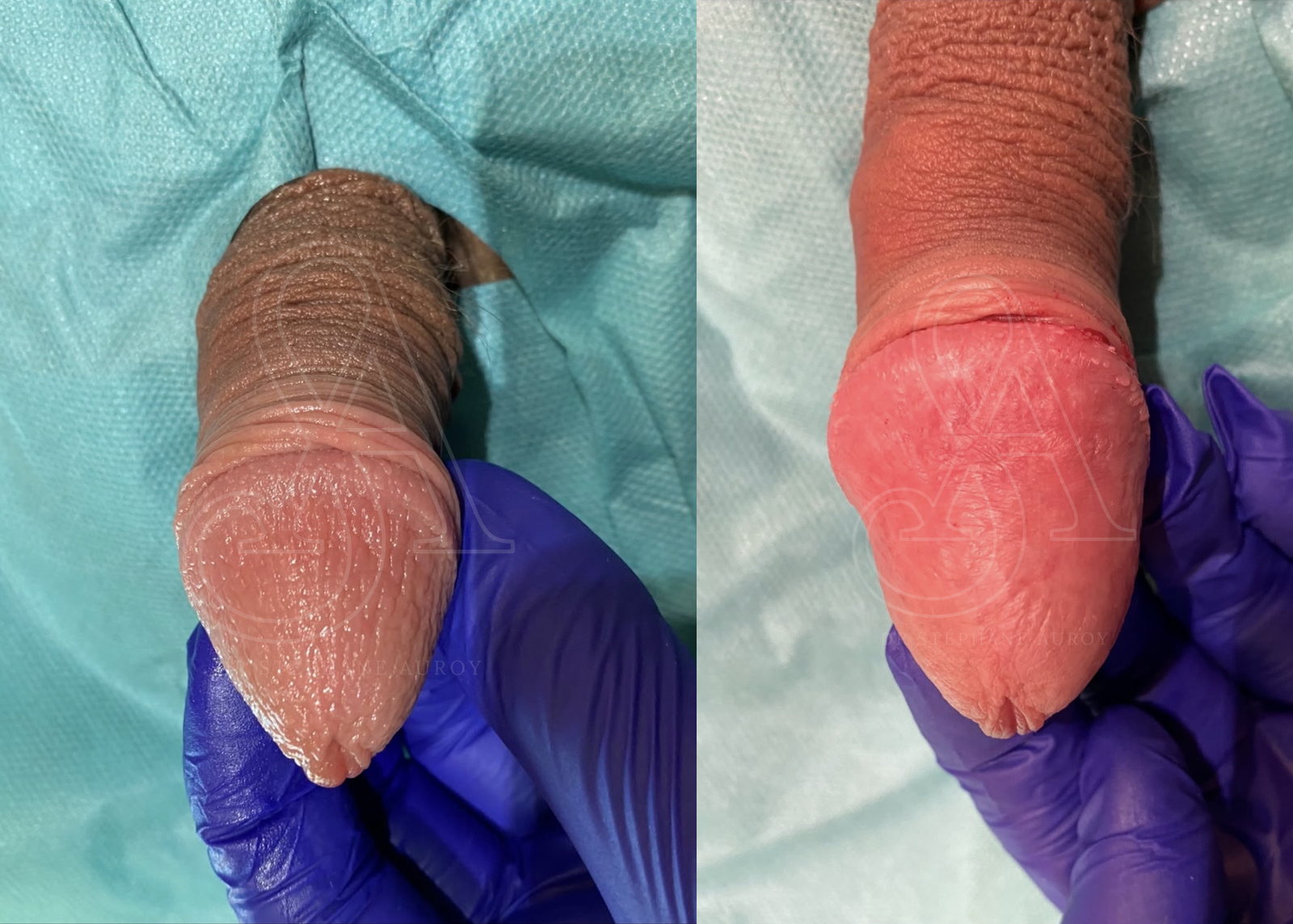 Photographie clinique avant et après une pénoplastie médicale — Dr Stéphane Auroy, Paris