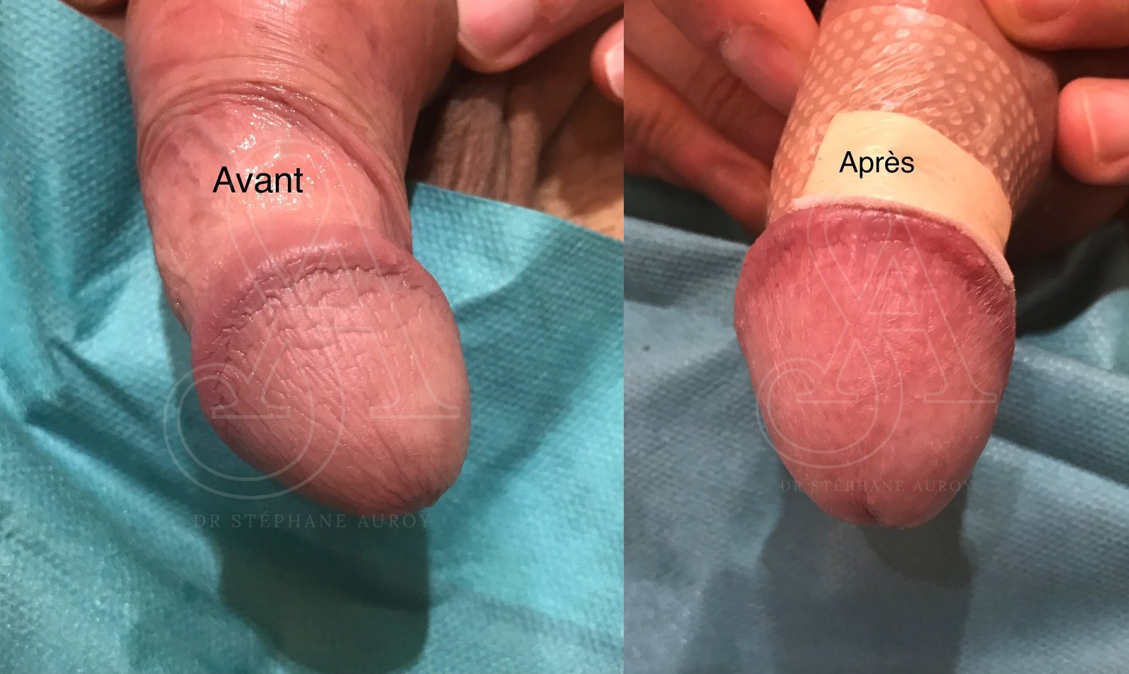 Photographie clinique documentant une pénoplastie médicale — Dr Stéphane Auroy, Paris
