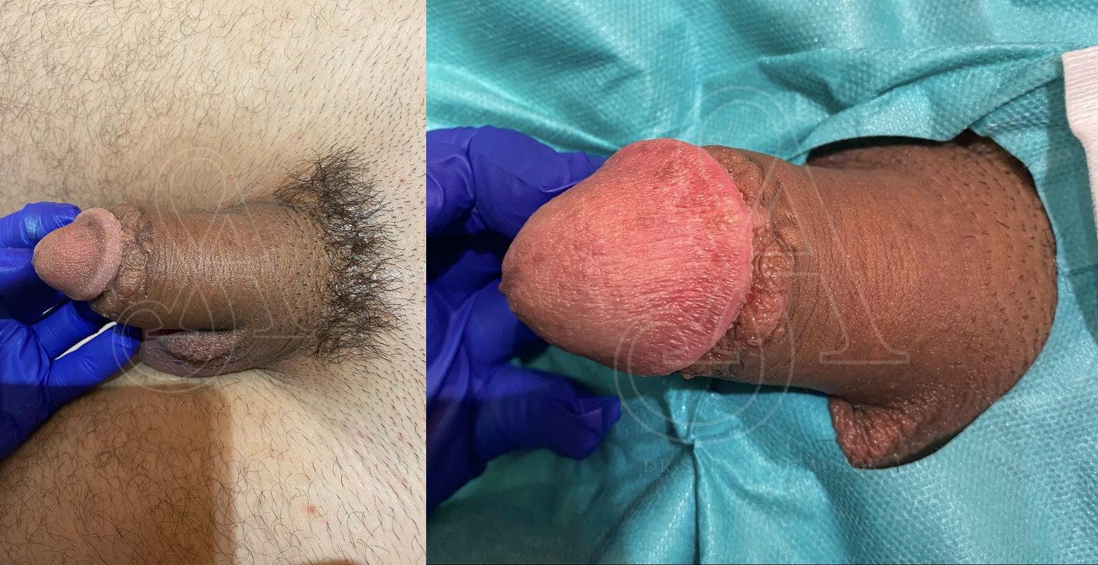 Photographie clinique avant et après une pénoplastie médicale — Dr Stéphane Auroy, Paris