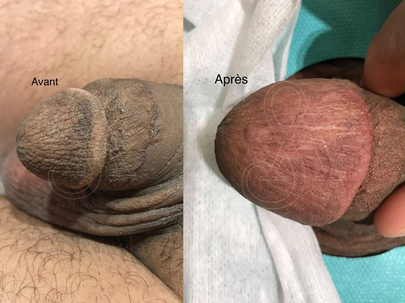 Photographie clinique documentant une pénoplastie médicale — Dr Stéphane Auroy, Paris