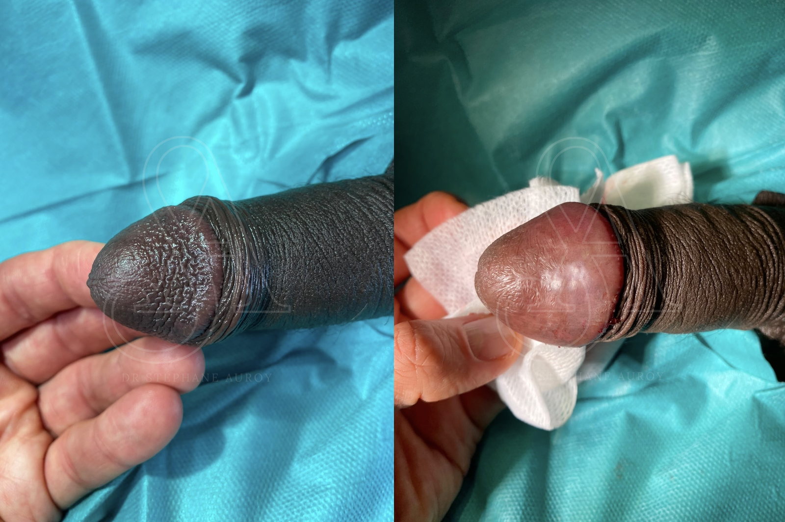 Photographie clinique avant et après une pénoplastie médicale — Dr Stéphane Auroy, Paris