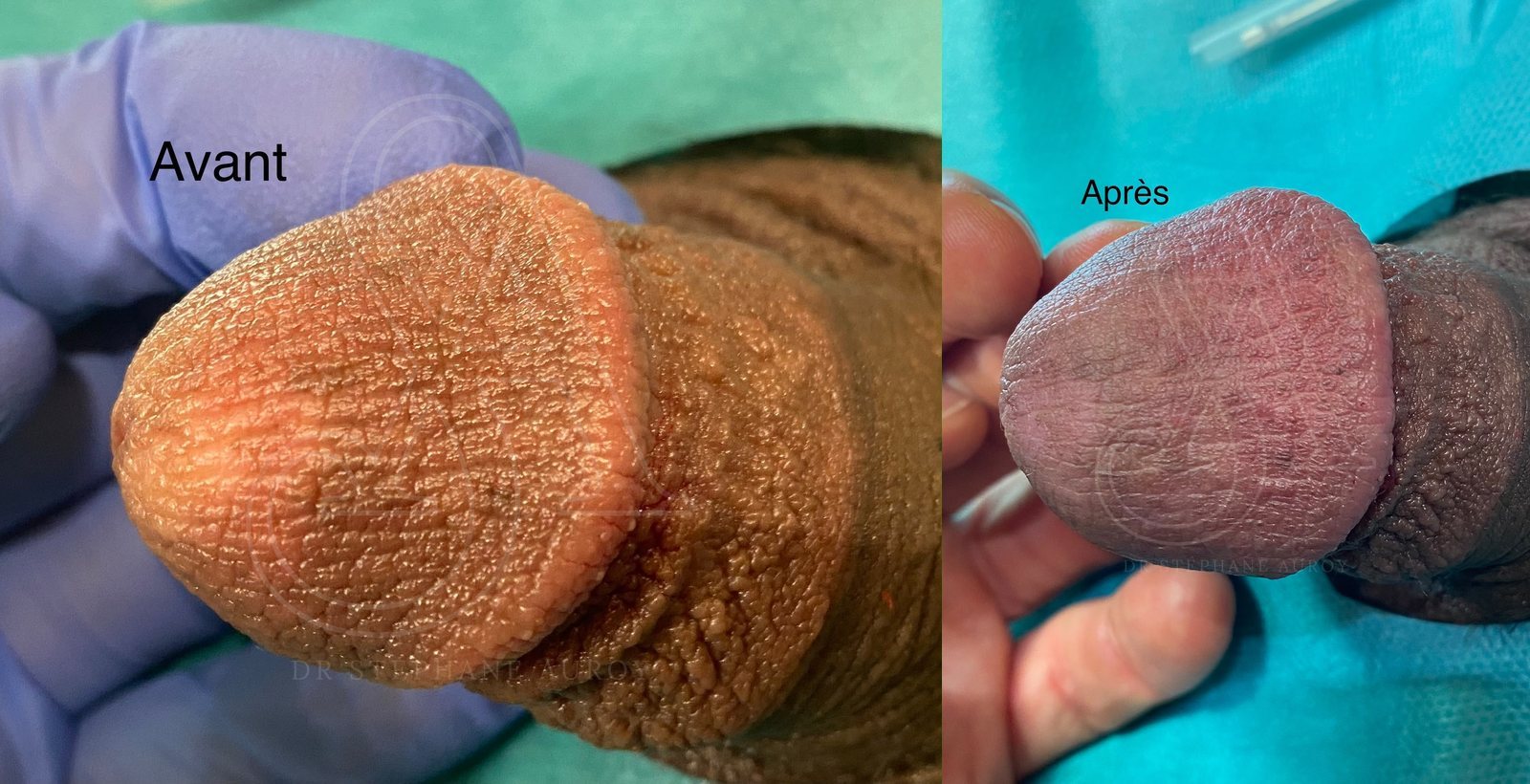 Photographie clinique documentant une pénoplastie médicale — Dr Stéphane Auroy, Paris