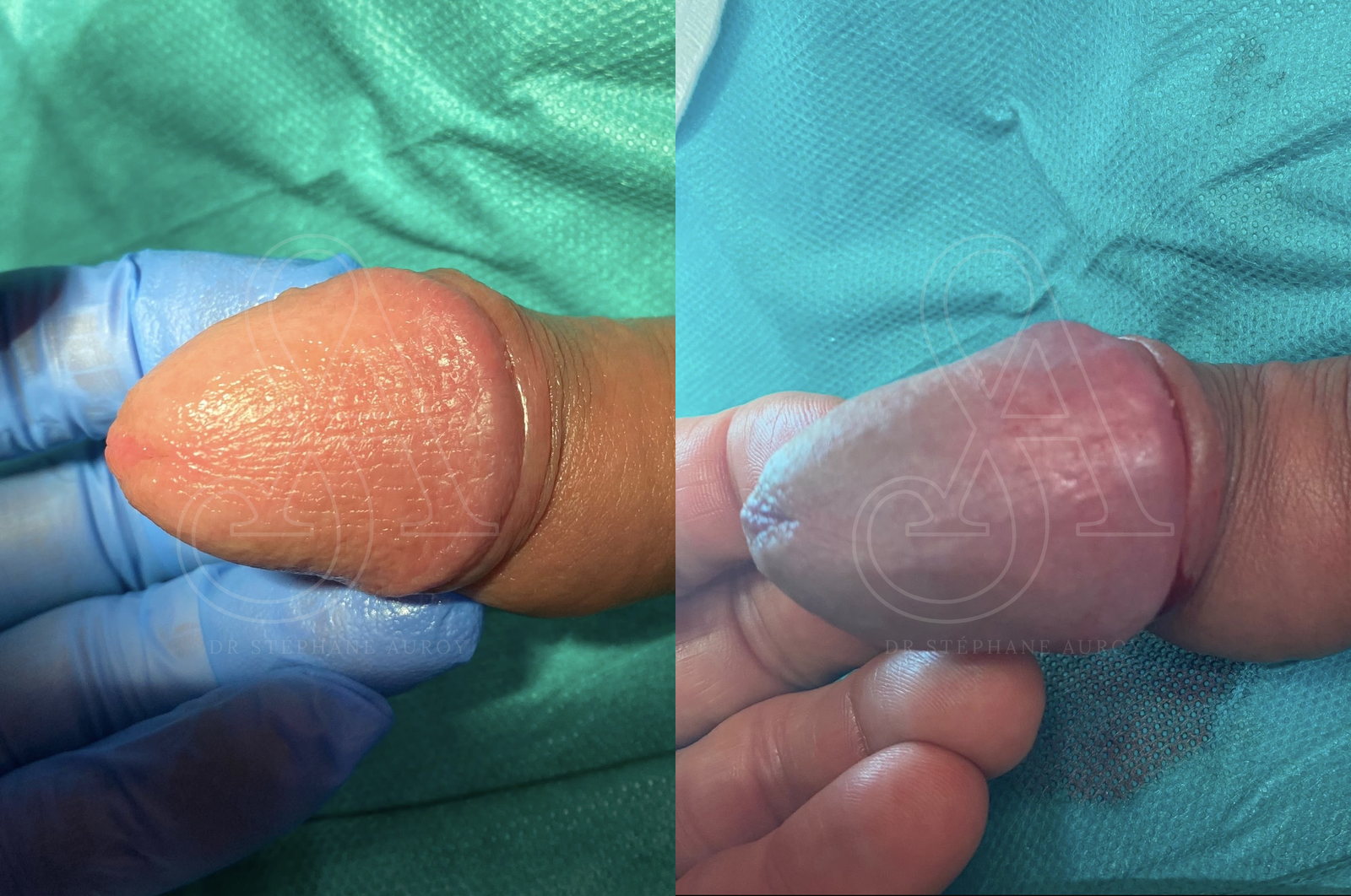 Photographie clinique avant et après une pénoplastie médicale — Dr Stéphane Auroy, Paris