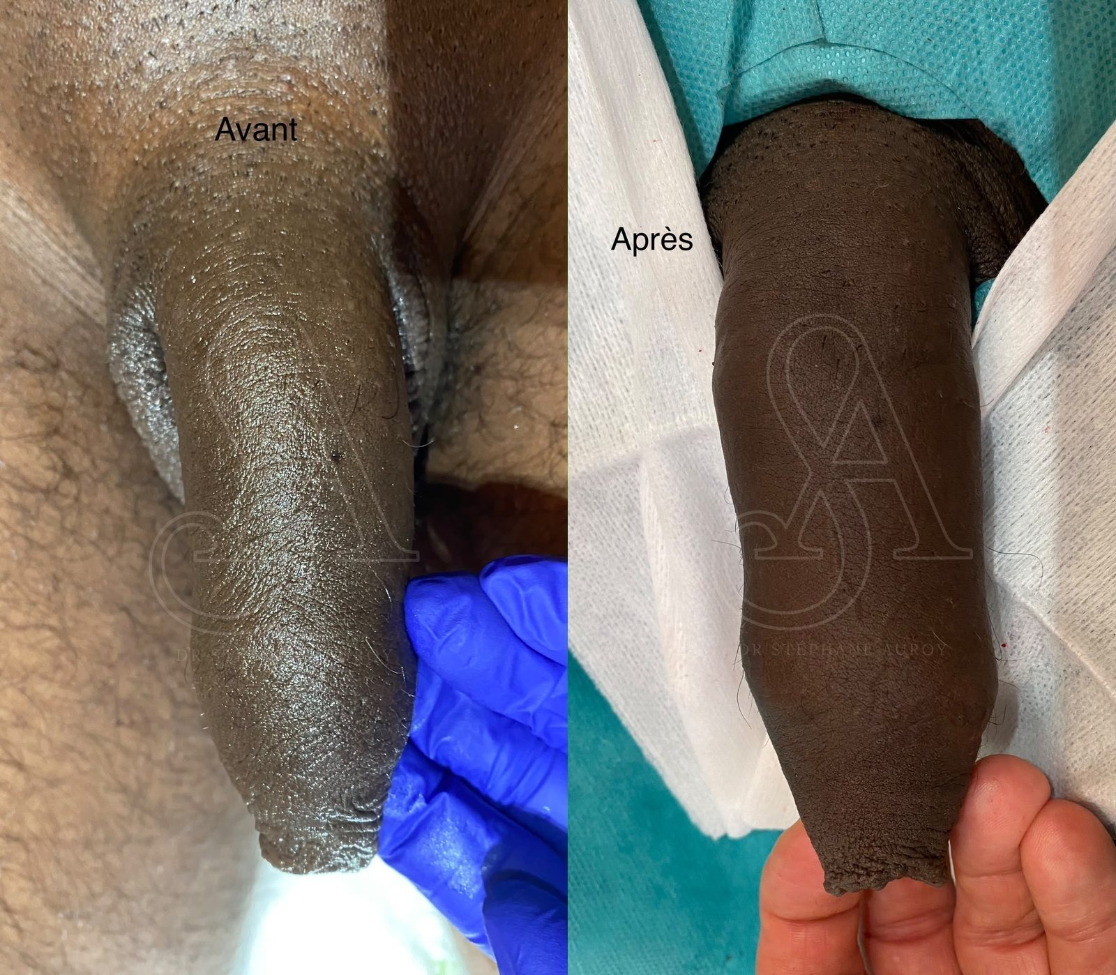 Photographie clinique documentant une pénoplastie médicale — Dr Stéphane Auroy, Paris