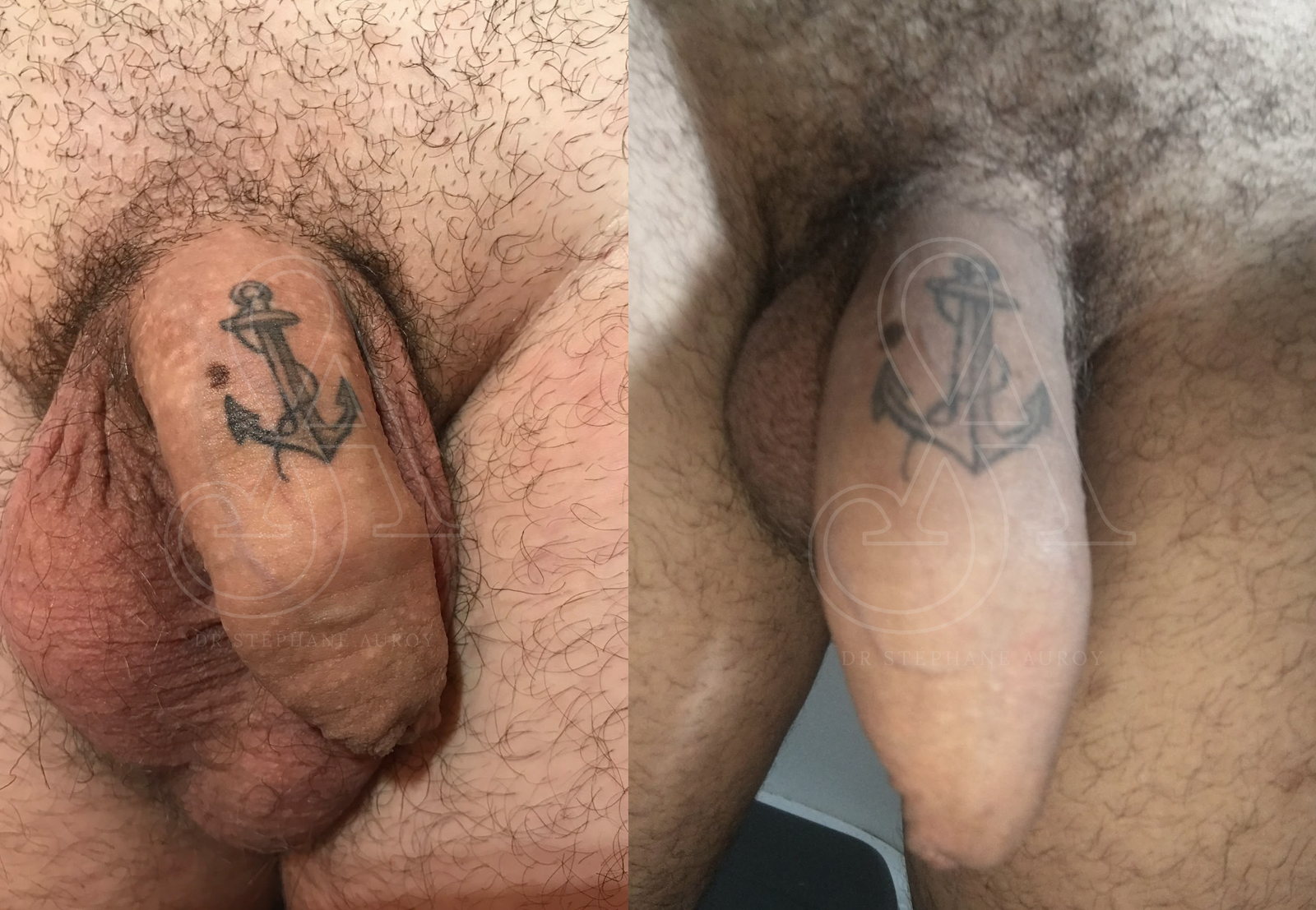 Photographie clinique avant et après une pénoplastie médicale — Dr Stéphane Auroy, Paris