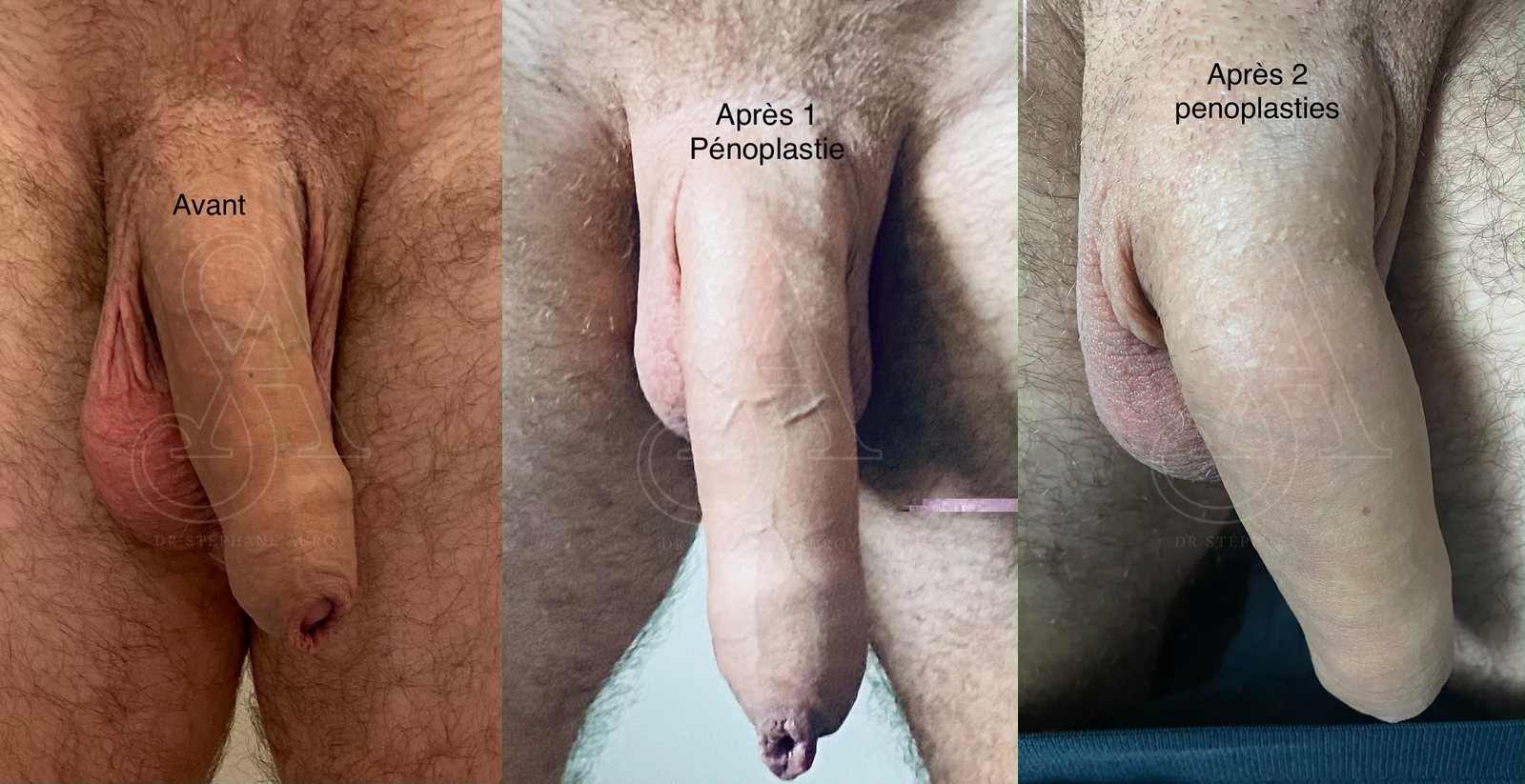 Photographie clinique documentant une pénoplastie médicale — Dr Stéphane Auroy, Paris