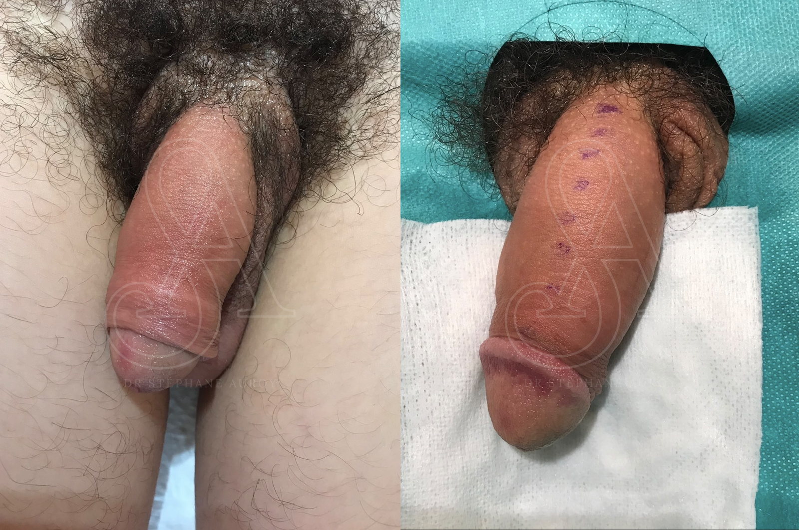 Photographie clinique avant et après une pénoplastie médicale — Dr Stéphane Auroy, Paris