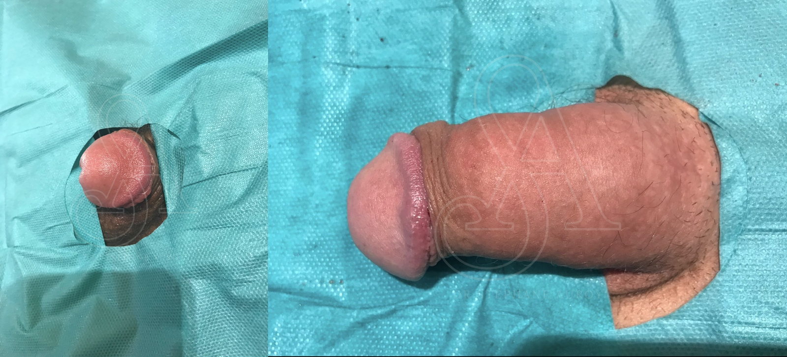Photographie clinique avant et après une pénoplastie médicale — Dr Stéphane Auroy, Paris