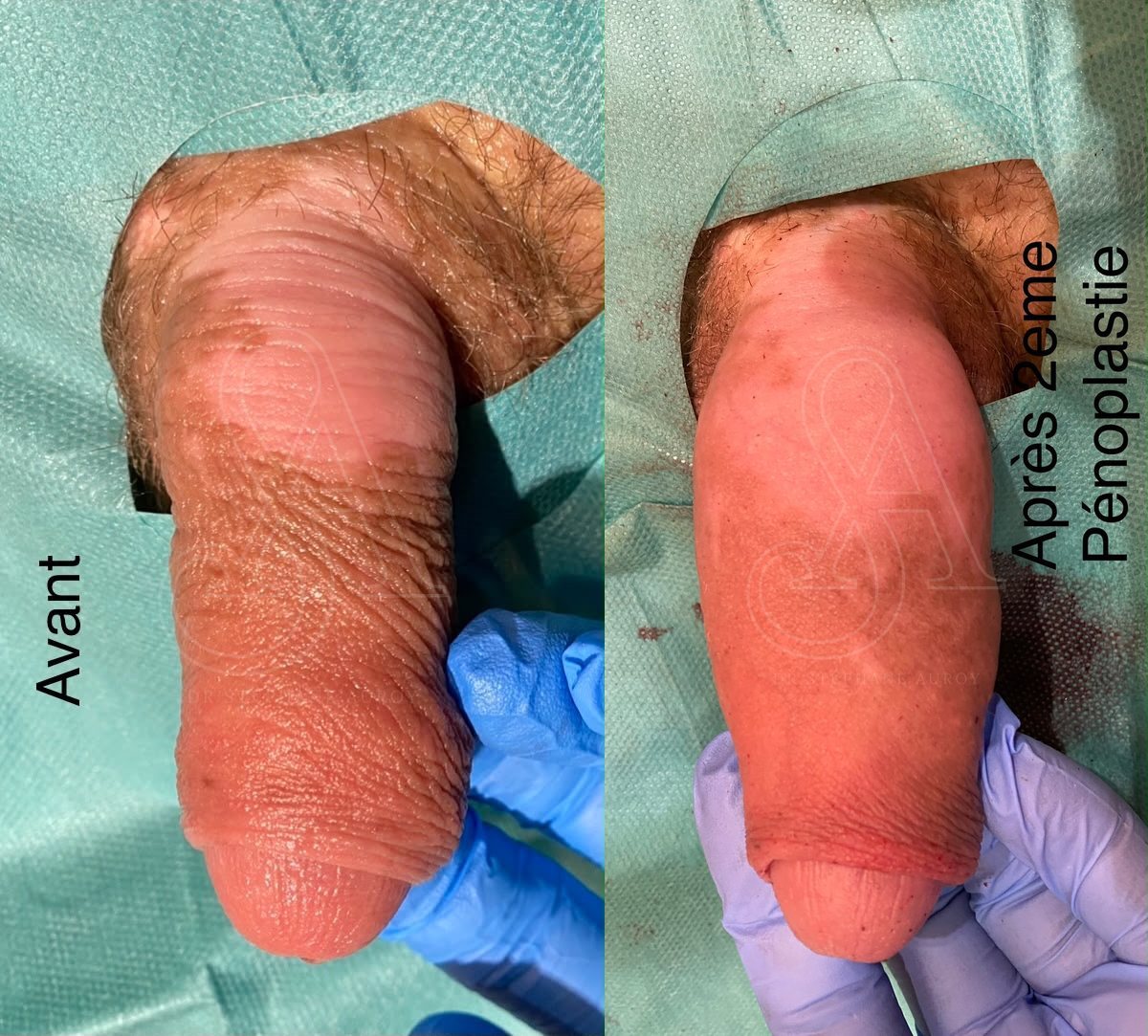 Photographie clinique documentant une pénoplastie médicale — Dr Stéphane Auroy, Paris