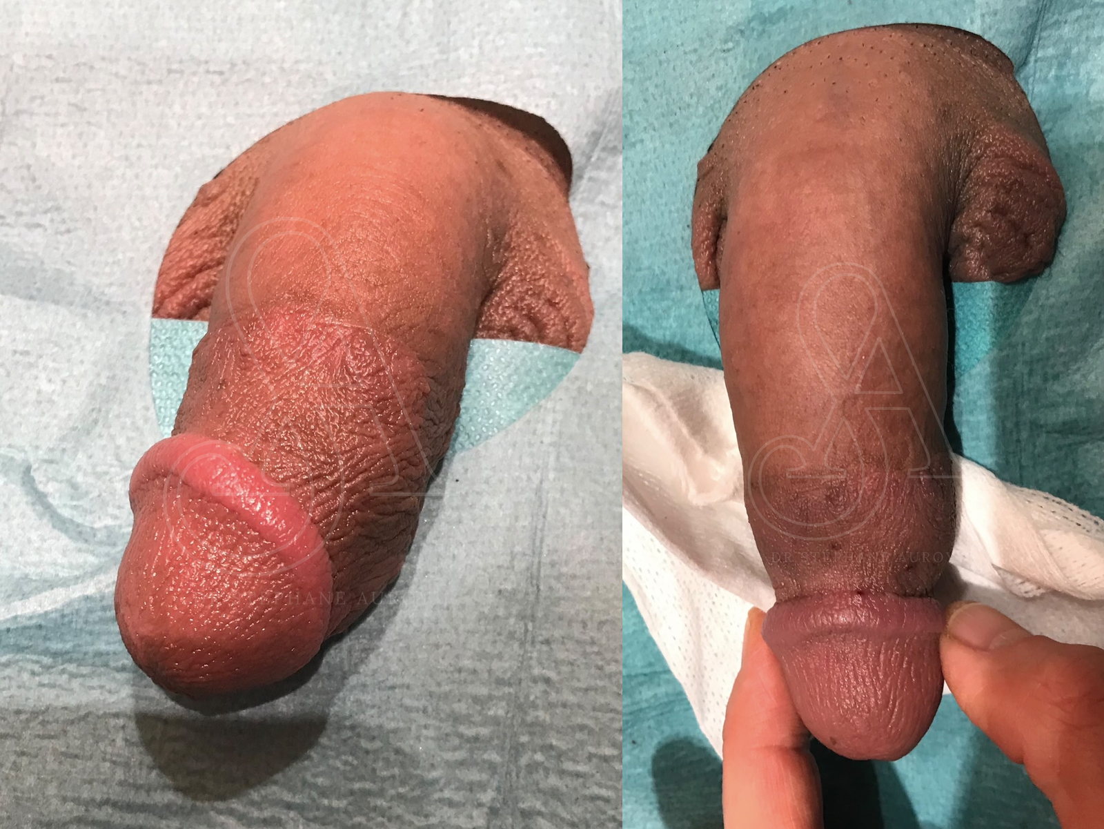 Photographie clinique avant et après une pénoplastie médicale — Dr Stéphane Auroy, Paris
