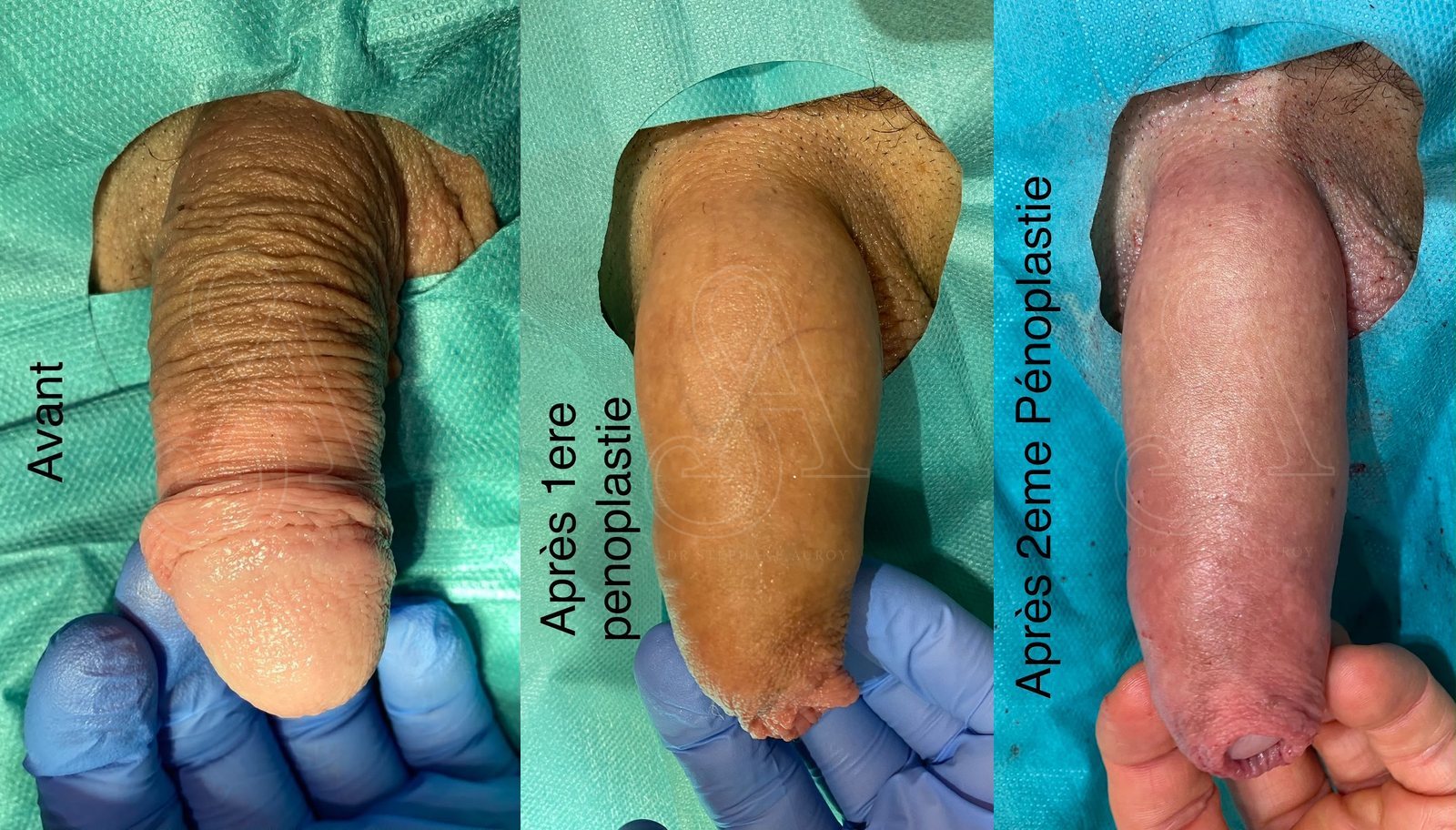 Photographie clinique documentant une pénoplastie médicale — Dr Stéphane Auroy, Paris