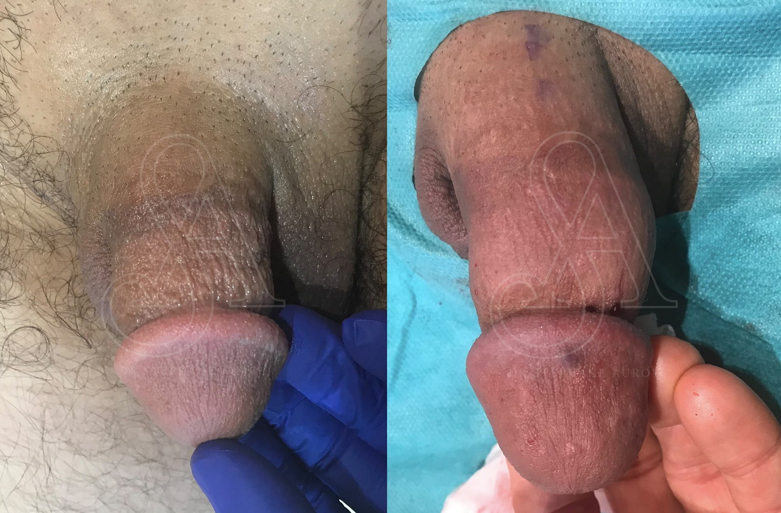 Photographie clinique avant et après une pénoplastie médicale — Dr Stéphane Auroy, Paris