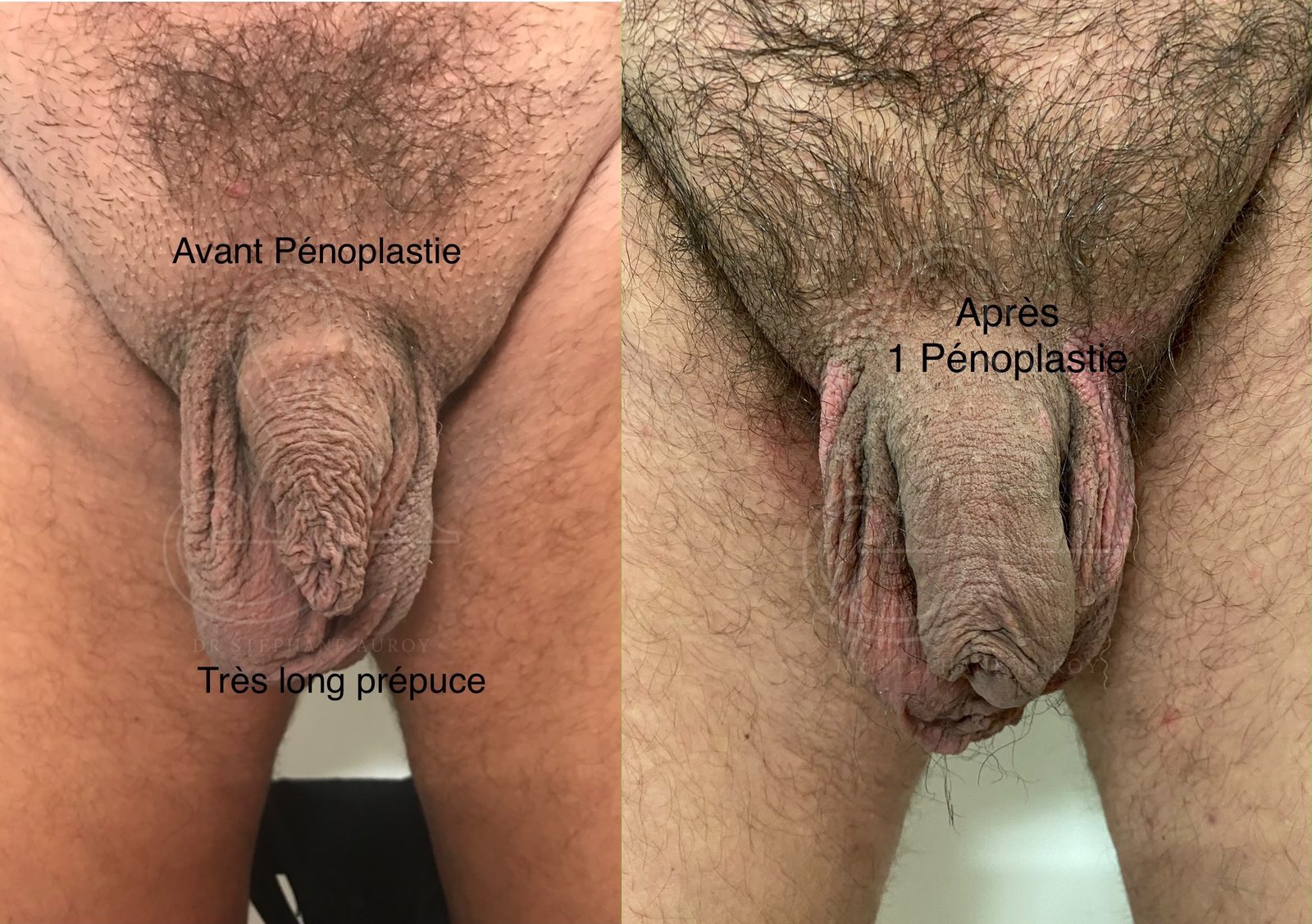 Photographie clinique documentant une pénoplastie médicale — Dr Stéphane Auroy, Paris