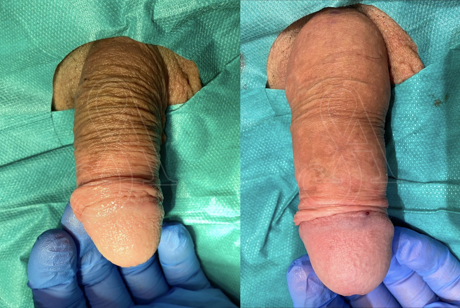 Photographie clinique avant et après une pénoplastie médicale — Dr Stéphane Auroy, Paris