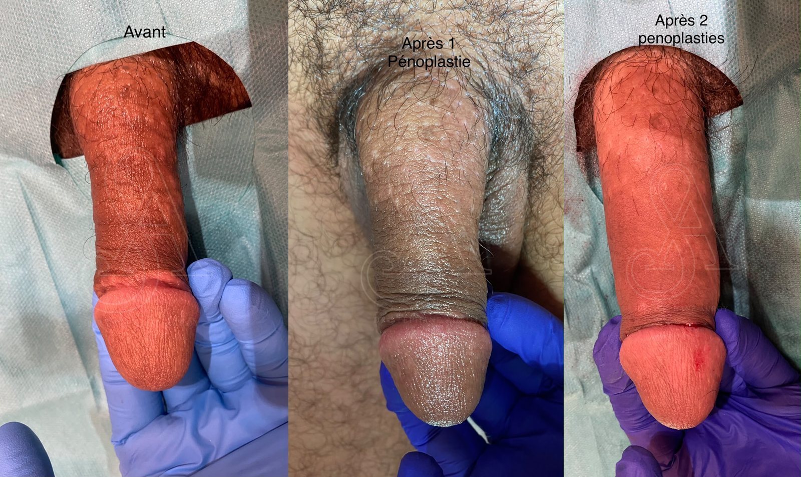 Photographie clinique documentant une pénoplastie médicale — Dr Stéphane Auroy, Paris