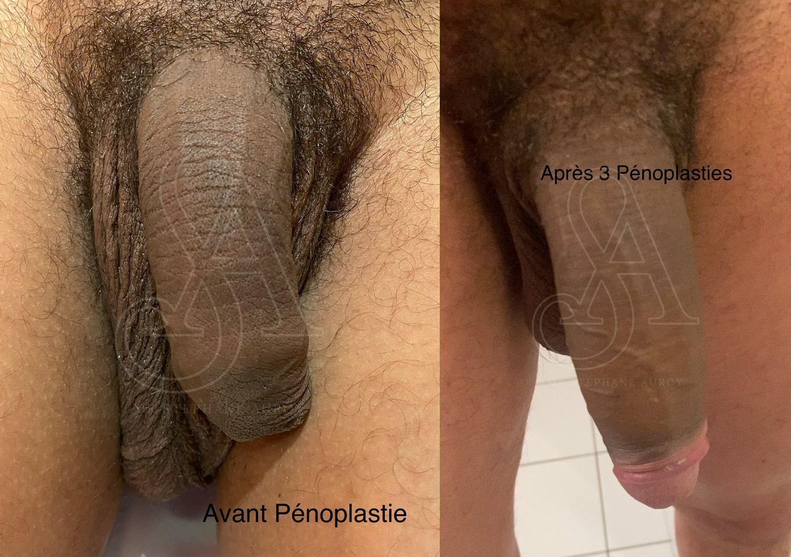 Photographie clinique documentant une pénoplastie médicale — Dr Stéphane Auroy, Paris