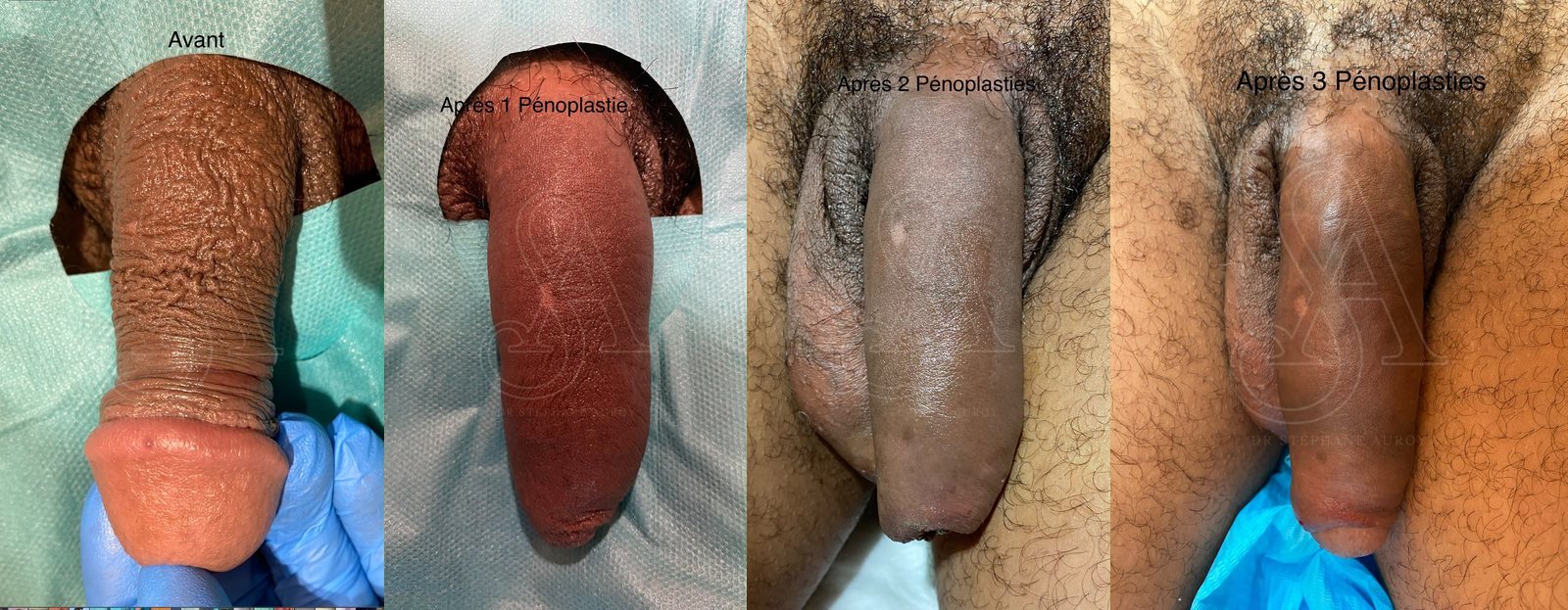 Photographie clinique documentant une pénoplastie médicale — Dr Stéphane Auroy, Paris