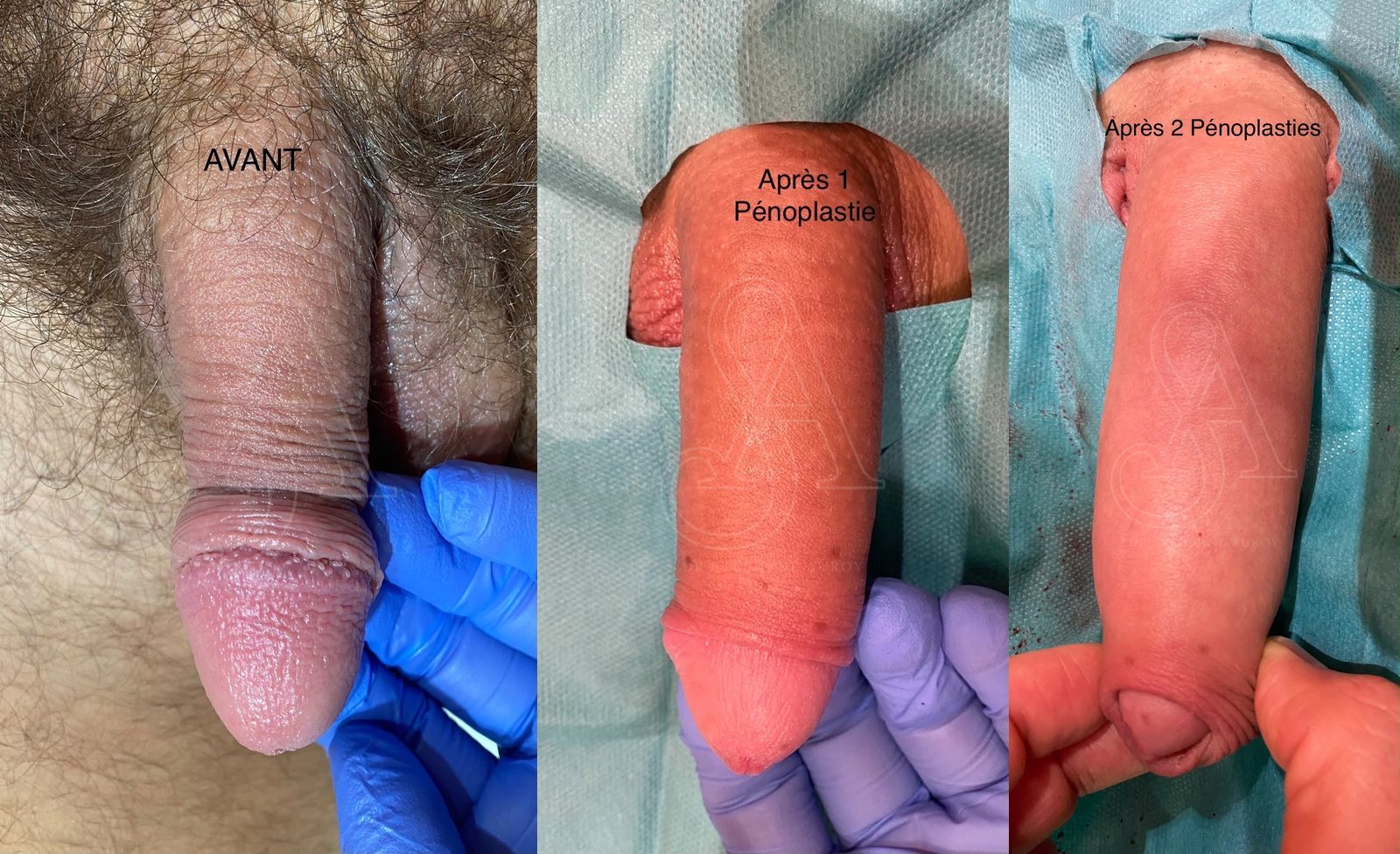 Photographie clinique documentant une pénoplastie médicale — Dr Stéphane Auroy, Paris