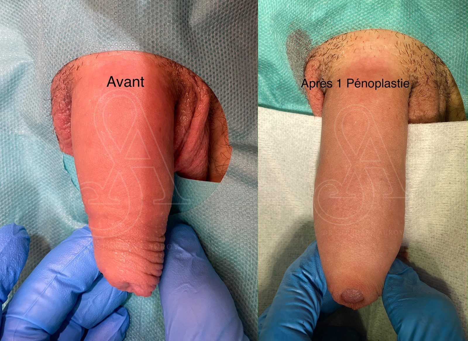 Photographie clinique documentant une pénoplastie médicale — Dr Stéphane Auroy, Paris