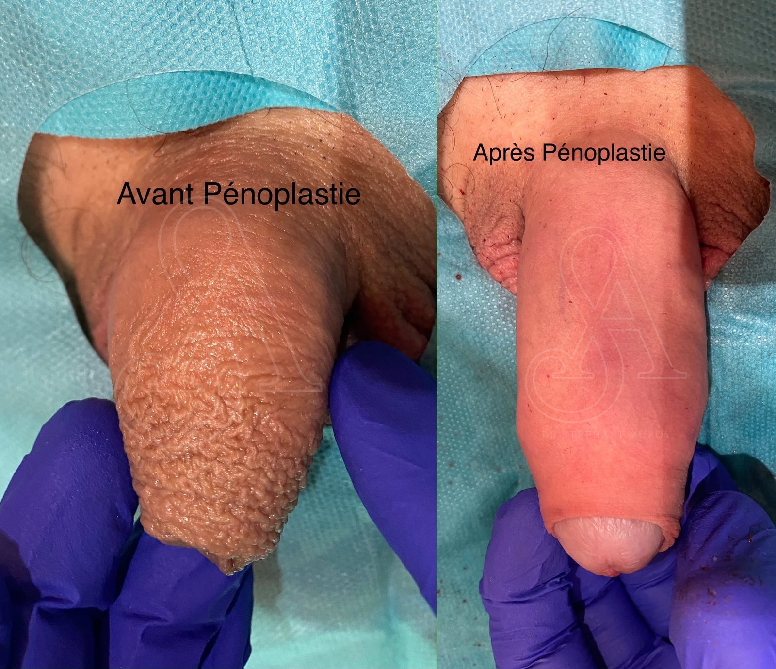 Photographie clinique documentant une pénoplastie médicale — Dr Stéphane Auroy, Paris