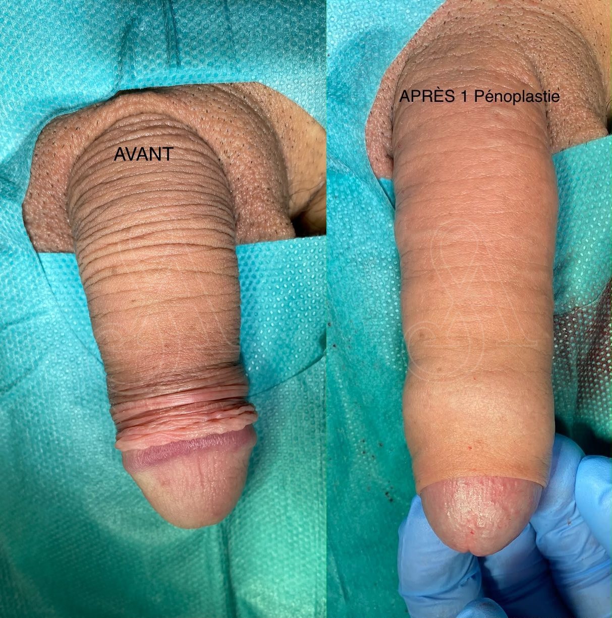 Photographie clinique documentant une pénoplastie médicale — Dr Stéphane Auroy, Paris