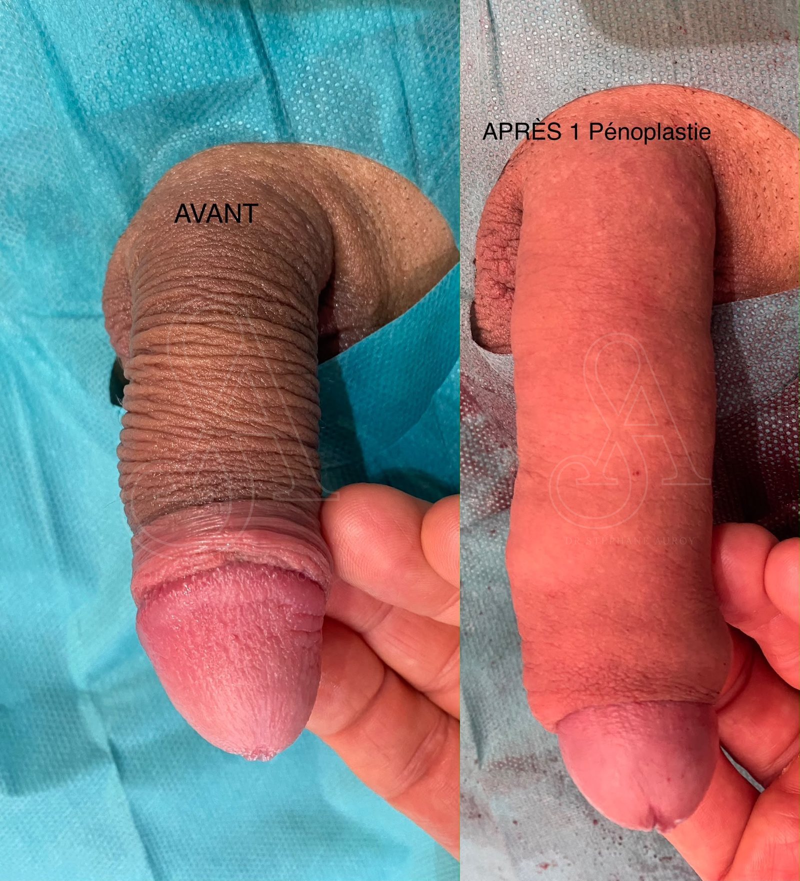 Photographie clinique documentant une pénoplastie médicale — Dr Stéphane Auroy, Paris